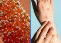 Confirman la primer muerte por Mpox en Jalisco